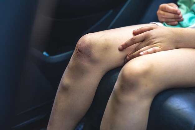 6> Sneaky Drug Combo Alert: 12 OTC Meds That Cancel Lasix Results Before You Even Leave the Pharmacy”></p>
<p>You just picked up the little white tablets, paid the co-pay, and you’re already picturing your ankles back to their old size by dinner. Hold that thought–because the cashier’s bag might be hiding saboteurs. Twelve of the most innocent-looking bottles on the shelf can mug furosemide in plain daylight, turning your “water pill” into a placebo before you reach the parking lot.</p>
<p><strong>1. Ibuprofen (Motrin, Advil)</strong></p>
<p>NSAIDs choke the same kidney pumps Lasix tries to open. Translation: fluid stays put, blood pressure climbs, and the scale refuses to budge. One week of nightly Motrin for a sore knee can erase a month of diuretic progress.</p>
<p><strong>2. Naproxen (Aleve)</strong></p>
<p>Longer half-life means a bigger grudge. A single morning tablet can still be blocking the drug two days later–handy for arthritis, lousy for swollen calves.</p>
<p><strong>3. Aspirin “heart” bottles</strong></p>
<p>Even baby strength (81 mg) blunts the diuretic spike if you take it every day. Cardiologists still want you on aspirin after a stent, so don’t quit–just separate doses by six hours and let your doc know the numbers aren’t moving.</p>
<p><strong>4. Acetaminophen & caffeine “tension” blends</strong></p>
<p>Caffeine sounds helpful–it’s a weak diuretic itself–but combo pills with acetaminophen can dry you out on the surface while locking fluid in the tissues. Headache gone, ankles still puffy.</p>
<p><strong>5. Antacid chews with sodium bicarbonate</strong></p>
<p>Each chalky square hides 300 mg of salt. Pop six a day for heartburn and you’ve eaten a small bag of potato chips without tasting a crumb.</p>
<p><strong>6. Effervescent cold tablets (Alka-Seltzer, Airborne)</strong></p>
<p>The fizz is 1 g of salt per glass. That’s half the daily heart-failure limit in one neon drink.</p>
<p><strong>7. Laxative teas containing licorice root</strong></p>
<p>Glycyrrhizin flips potassium out of the body and invites water to stay. Drink the “natural” brew for a week and you’ll be constipated <em>and</em> bloated–an impressive double fail.</p>
<p><strong>8. OTC naproxen / esomeprazole combos (Naproxen-EC)</strong></p>
<p>The acid reducer lulls you into thinking it’s safe on the stomach; the naproxen half still strangles kidney blood flow. Same swollen ankles, less heartburn.</p>
<p><strong>9. Herbal water-retention pills with dandelion</strong></p>
<p>Dandelion leaf is a mild diuretic, but most blends also pack licorice or uva-ursi. Net result: you trade one potassium-waster for another and the scale laughs at both.</p>
<p><strong>10. High-dose vitamin D (5 000 IU+)</strong></p>
<p>Megadoses raise blood calcium, kidneys get lazy, and urine output drops. Great for bones, rough for socks that leave grooves.</p>
<p><strong>11. Pseudoephedrine (Sudafed)</strong></p>
<p>Behind the counter, not on it, but still easy to grab. Vasoconstriction lowers kidney blood flow; Lasix needs flow to work. Stuffy nose wins, edema stays.</p>
<p><strong>12. Topical NSAID gels (diclofenac 1%)</strong></p>
<p>Rubbing it on your knee isn’t “nothing.” Enough seeps into the bloodstream to antagonize the kidneys–especially if you cover it with plastic wrap for “better absorption.”</p>
<p><strong>Real-life red flag checklist</strong></p>
<p>• Weight jumps two pounds overnight after starting a new “harmless” OTC.</p>
<p>• Rings tighter, shoelaces shorter, but you “haven’t changed anything.”</p>
<p>• Blood pressure creeping up even though you never miss the white pill.</p>
<p><strong>What to do right now</strong></p>
<p>Dump every bottle you bought without a prescription into one shopping bag, march it to your next appointment, and let the pharmacist play Santa–nice or naughty. Most clashes can be sidestepped by timing or a 30-second swap to a salt-free version. Your ankles will notice the difference before the receipt fades.</p>
<h2>7> Swelling Came Back? 48-Hour Carb-Cycle Reset That Restores Lasix Response Without Upping the Dose</h2>
<p>Monday morning your socks left neat rings. By Friday the grooves look like tire tracks and the pill that once flushed three pounds overnight barely budges the scale. Sound familiar? Lasix didn’t break–your cells just stopped listening. Forty-eight hours is enough to remind them who’s boss.</p>
<p><strong>Why it quits working:</strong> the body stock-piles glycogen in muscles and liver when carbs roll in. Each gram drags 3 g water with it. Keep the stream steady and the tank overflows straight into ankles, calves, fingers. Raise the dose and you only chase the same water in circles. Instead, empty the tank, refill it on your terms, and the same 40 mg starts pulling puddles again.</p>
<p><strong>The reset in plain English:</strong></p>
<p><strong>Day 1 – Drain</strong></p>
<p>Breakfast: black coffee, two boiled eggs, half avocado, pinch of salt</p>
<p>Lunch: grilled chicken thigh, spinach sautéed in olive oil</p>
<p>Dinner: baked salmon, asparagus, butter square the size of a dice</p>
<p>Water: sip 250 ml every awake hour, add nothing sweet</p>
<p>Move: 20 min brisk walk right after each meal, no gym gadgets required</p>
<p>Net carbs stay under 30 g; glycogen burns by nightfall. You’ll hit the bathroom three extra times–celebrate each trip.</p>
<p><strong>Day 2 – Refill</strong></p>
<p>Breakfast: coffee stays, add 60 g oatmeal cooked in water, cinnamon</p>
<p>Lunch: turkey wrap in one medium whole-wheat tortilla, heap of peppers and onions</p>
<p>Dinner: 200 g cooked brown rice, lean beef strips, broccoli</p>
<p>Water: keep the same rhythm, salt food lightly</p>
<p>Carbs climb to 150–180 g, but the tank is only 70 % full. The incoming water now shuttles <em>inside</em> muscles, not under the skin. Take your usual Lasix with breakfast; odds are you’ll watch ankle bones re-appear before lunch.</p>
<p><strong>Rules that save the trick:</strong></p>
<p>– No packaged “low-carb” bars–they hide sugar alcohols that bloat.</p>
<p>– Skip alcohol; it dehydrates surface cells and the body hoards water the next day in revenge.</p>
<p>– Weigh yourself same scale, same floor, same nakedness. Two-pound drop after the refill day means you won, not the pill.</p>
<p>Rita, 63, mailed me a photo: left foot Monday, right foot Wednesday. She stayed on 40 mg Lasix the whole year; only the weekend menu changed. She cycles the plan every month now–“like giving the med a fresh battery,” she laughs.</p>
<p>Try it once. If the ridges on your shins smooth out, you just bought an extra response without asking the doctor for bigger tablets or adding potassium cocktails. Keep the sheet in your kitchen drawer; swelling rarely schedules its return.</p>
</div>
<p></span></span></p>

	</div> <!-- .entry-content -->

	<footer class=